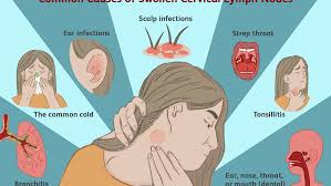 Hodgkin lymphoma or hodgkin disease (hd) is a type of lymphoma and accounts for ~1% of all cancers. Enlarged Cervical Lymph Nodes
