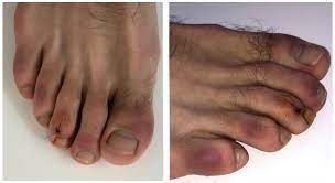 Rash cutanei nel 20 per cento dei malati. Manifestacoes Cutaneas Associadas A Covid 19 Uma Analise Critica Dos Dados Pebmed