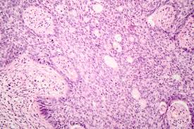 It's pretty disturbing, so disturbing that if you do it, you'll be down that microscopic rabbit hole for at least an hour, marveling at all the grossness. Basal Cell Carcinoma Skin Cancer Light Micrograph Photo Under Stock Photo Picture And Royalty Free Image Image 110119168
