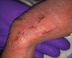 Disseminated herpes simplex virus (hsv) in a neonate. Bullous Lesions In A Neonate Mdedge Dermatology