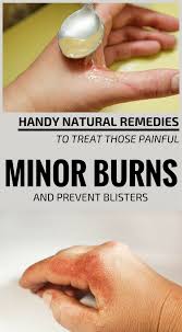 Handy Natural Remedies To Treat Those Painful Minor Burns Home Remedies For Burns Burn Skin Home Remedies Burns Treatment