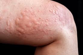 Image result for allergy rash on the legs