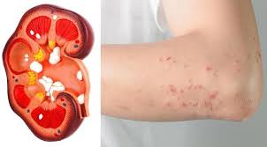 8 Kidney Damage Symptoms Most People Ignore Kidney Failure Symptoms Kidney Damage Chronic Kidney Disease