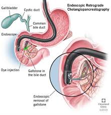 Demi lovato put her stretch marks. Gallstones Treatment Definition Risk Factors Symptoms