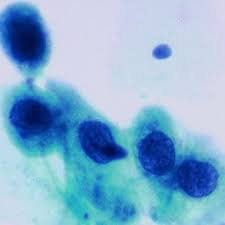 The cervix or cervix uteri is the lower part of the uterus in the human female reproductive system. Pdf Atypical Squamous Metaplastic Cells
