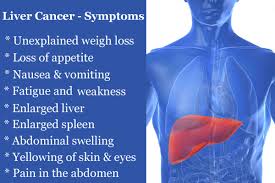 These years more and more people are suffering from such disease.there are three the obvious pain feeling in liver. Liver Cancer Signs Types Of Liver Cancer