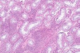 Later, under the influence of sertoli cells, the leydig cells develop (ge et al. Leydig Cell Hyperplasia Libre Pathology