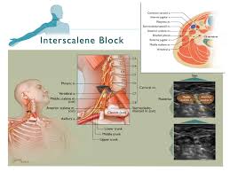 Image result for Superior Trunk Block