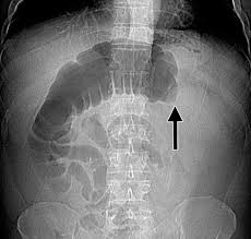 It should be no lower than. Large Bowel Obstruction In The Adult Classic Radiographic And Ct Findings Etiology And Mimics Radiology