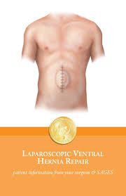 Epigastric hernia is a common type of hernia which results due to some weakness or tear in the muscles of the abdomen. Laparoscopic Ventral Hernia Repair Information From Sages