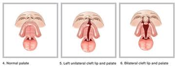 Image result for Cleft Lip