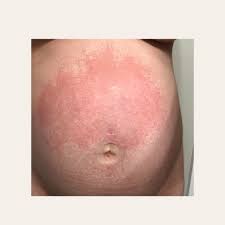 Image result for pruritic urticarial papules and plaques of pregnancy