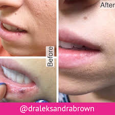 However, they can gradually enlarge to about a consult a dermatologist about the appropriate method of removal. Cosmetic Services River Ridge Dermatology
