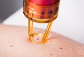 Most moles are harmless and do not require treatment. Mole Removal Surgery Home Remedies Treatments