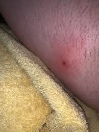 Sometimes, dead skin can clog a hairfollicle. Don T Know If It S An Ingrown Hair Or Just A Pimple But It Hurts Like A Bitch Popping