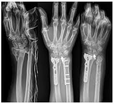 Image result for Forearm Fracture