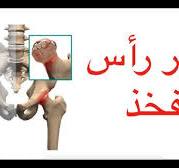 ‫Osteonecrosis / تنخر رأس الفخذ و هل يؤدي الى خشونة الورك؟‬‎