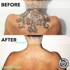 2030 fleischmann road tallahassee, fl 32308 phone: Laser Tattoo Removal At Wa Ink By Mjdriverlasertattooremoval And Swlaser Tattooremoval 7 Treatments Total Tattoo Removal Laser Tattoo Removal Laser Removal