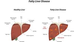 Translate diagram in hindi language. World Liver Day 2018 Follow This Diet Recommended By A Nutritionist To Manage Fatty Liver Thehealthsite Com