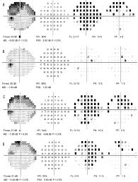Image result for Visual Field Deficit