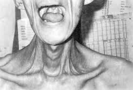 Image result for Progressive Bulbar Paralysis