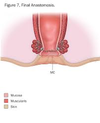 Image result for Rectal prolapse