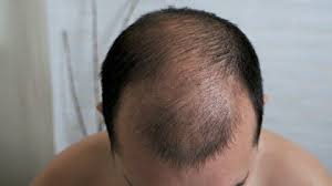 Hair grows from special structures under the skin called follicles. Male Pattern Hair Loss Stock Video Footage 4k And Hd Video Clips Shutterstock