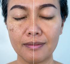 Image result for Melasma