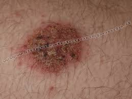 Image result for Eczema nummulare