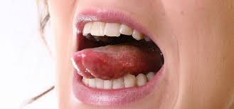 Image result for Puchýře na jazyku