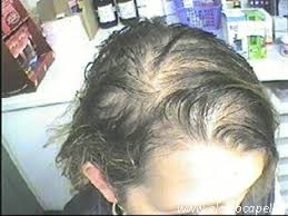 Ecco le principali cause dei capelli grassi e le soluzioni · 1) scompensi ormonali e predisposizione genetica · 2) alimentazione sregolata e poco . Trattamento Per Capelli Grassi Alesco Capelli