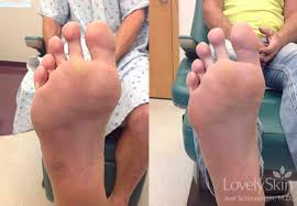 Plantar warts exclusively grow on the soles of the feet and in some cases even palms. Omaha Dermatology Wart Removal Skin Specialists Pc Lovelyskin