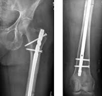 FRN-ADVANCED™ Femoral Recon Nailing System