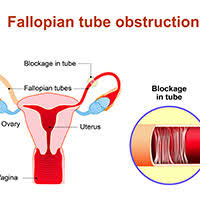 Charles patrick davis, md, phd. Uterine Cancer Causes Symptoms And Treatment