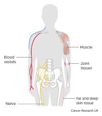 However, malignant soft tumors are also a possibility, explains cleveland clinic. What Is Soft Tissue Sarcoma Cancer Research Uk