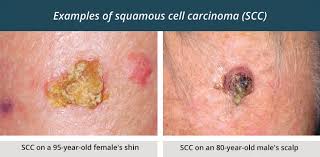 Merkel cell carcinoma is a rare but aggressive skin cancer that starts in skin exposed to the sun, typically on the head, scalp, neck, arms, legs, and trunk. Scc Symptoms Diagnosis And Treatment Healthdirect