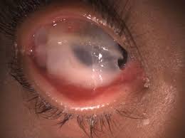 Image result for Gonococcal Conjunctivitis