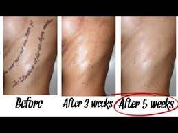Removing tattoos at home could leave you with serious problems on your hands: How Can I Remove A Tattoo Elegant Arts Tattoo