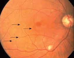 Image result for Acute Vision Loss