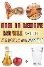 How To Remove Ear Wax With Vinegar And Water Ear Wax Ear Wax Removal Clean Ear Wax Out
