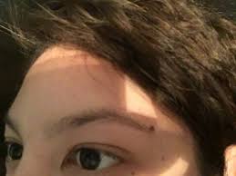 Asian blepharoplasty double eyelid with medial epicanthoplasty live surgery by seattle dr. Plastic Surgeon Dr Dean Kane Of Baltimore Answers Question Regarding Epicanthal Or Asian Eyelid Fold Options Dr Dean Kane
