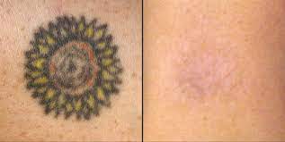 The lover whose name you got tattooed, in a gust of sudden elation, dumped you? Natural Tattoo Removal