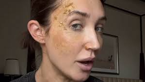 TV-stjernen Megan McKenna i ulykke: Viser frem brannskaden