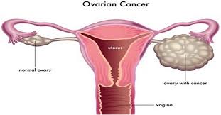The symptoms of ovarian cancer can be similar to those of other conditions making them difficult to recognize. Ovarian Cancer Causes Symptoms Diagnosis Survival Rate And Treatment