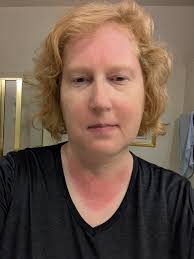 Sunscreen Protection and Sunburn Prevention