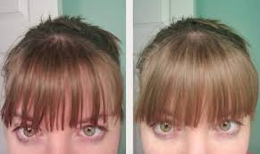 You may start to use minoxidil %5 to thicken the crown area and stop hair loss.you would better planning to have an exam at hair loss expert when you fell uncomfortable about hair styling. 32 Products That People With Thin Hair Will Probably Say Thank You To