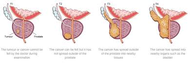 Image result for Prostate Cancer Staging