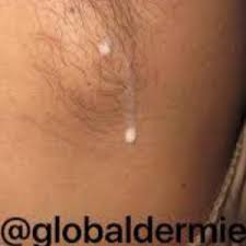 Desa di sebelah skul sd koe tuch,, sd n bulus ii tercinta. Jika Ibu Menyusu Syak Ada Breast Tambahan Di Ketiak Atas Dada Atau Pusat Rujuk Pakar Pa Ma