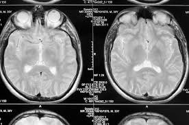 Epilepsi Haberleri Guncel Epilepsi Haberleri Ve Epilepsi Gelismeleri