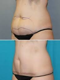 In a traditional (or full) abdominoplasty. Fox Valley Plastic Surgery Mini Tummy Tuck Surgery